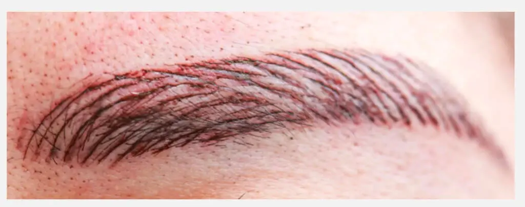Close-up of eyebrow showing visible scarring and hairstroke patterns from previous microblading treatment